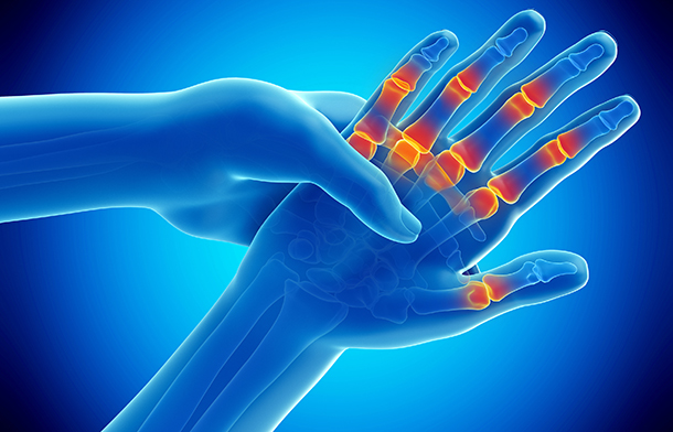 A Closer Look at Evolving Treatment Strategies for Rheumatoid Arthritis: A Live Virtual Symposium